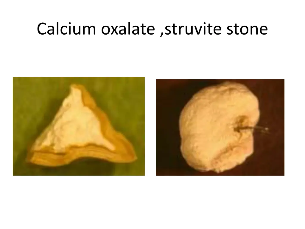 calcium oxalate struvite stone