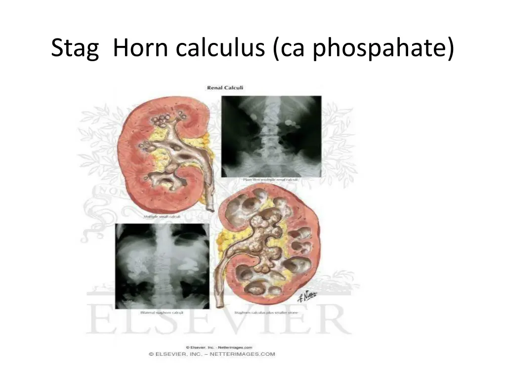 stag horn calculus ca phospahate