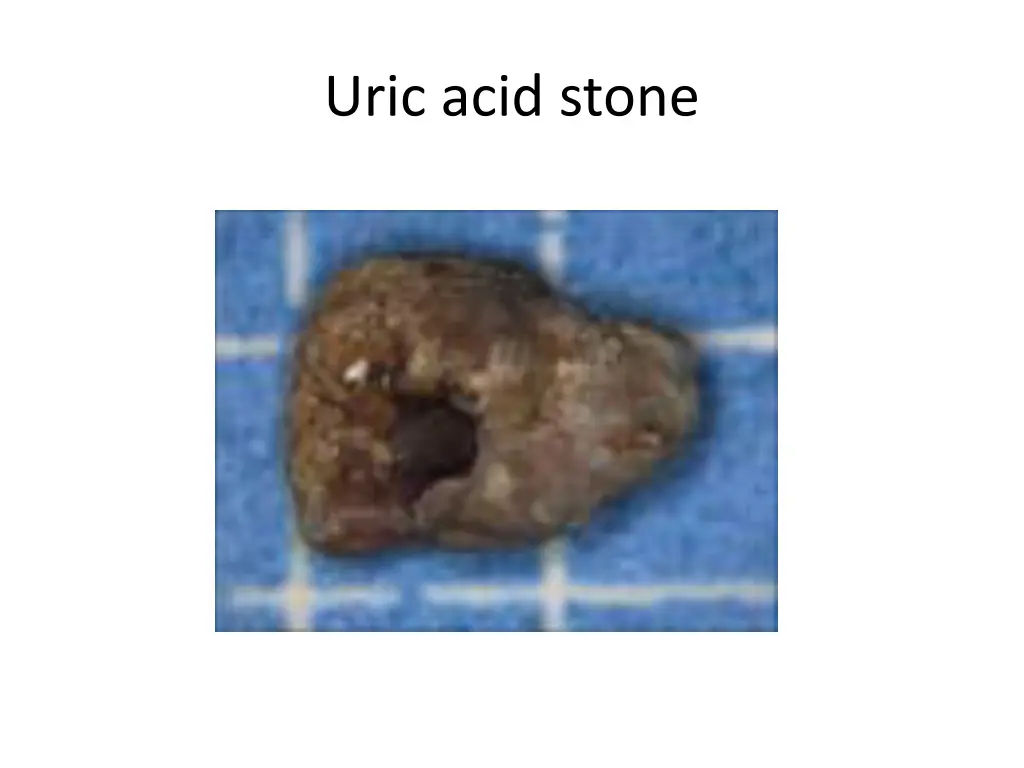 uric acid stone