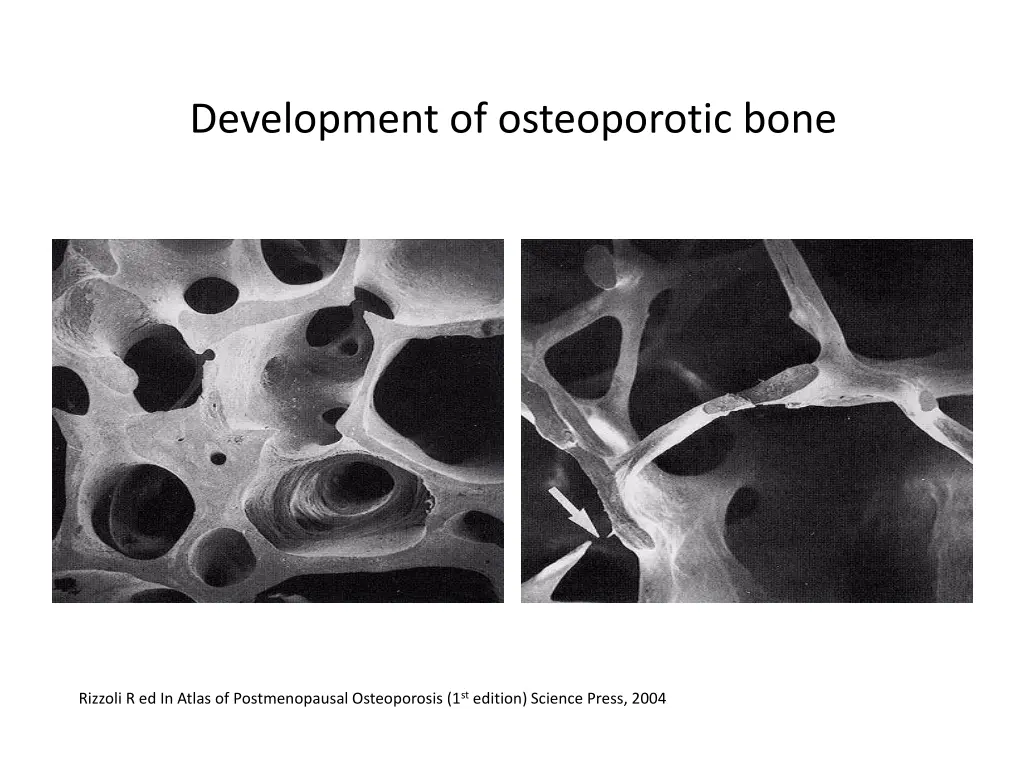 development of osteoporotic bone