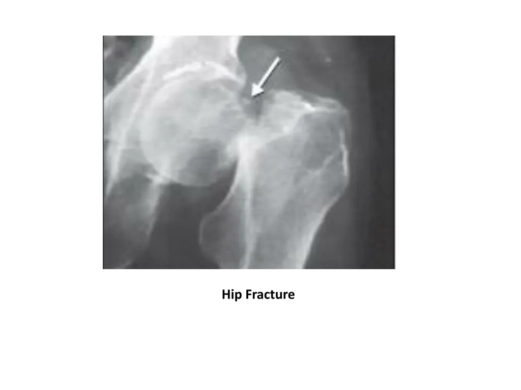 hip fracture