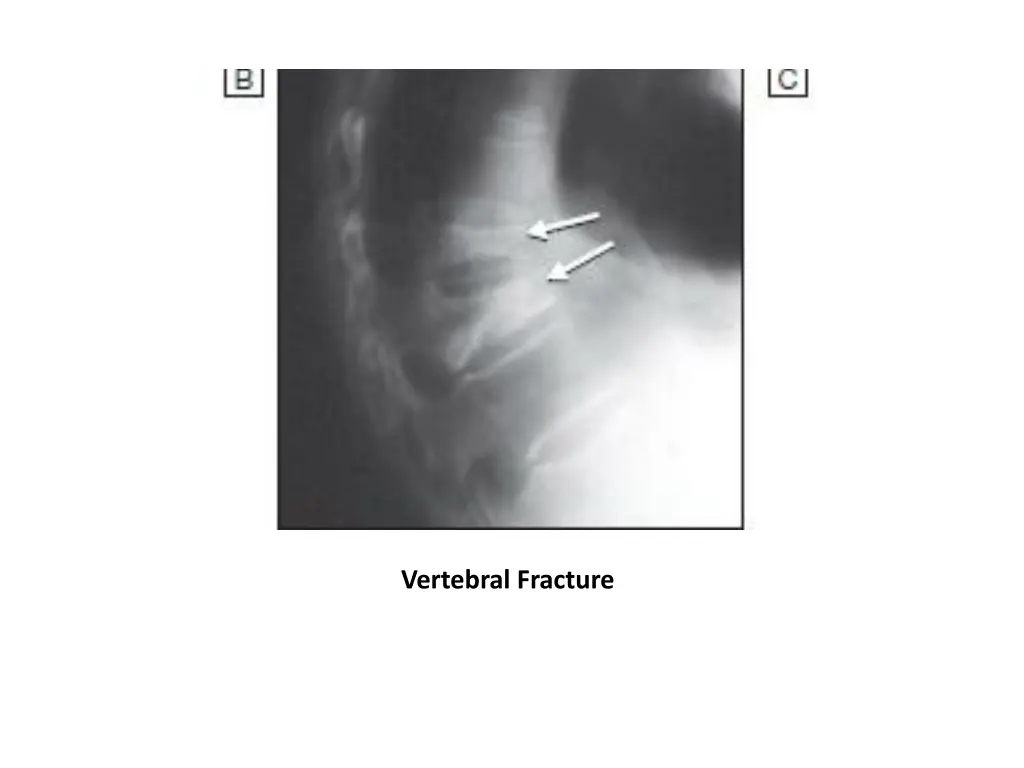 vertebral fracture