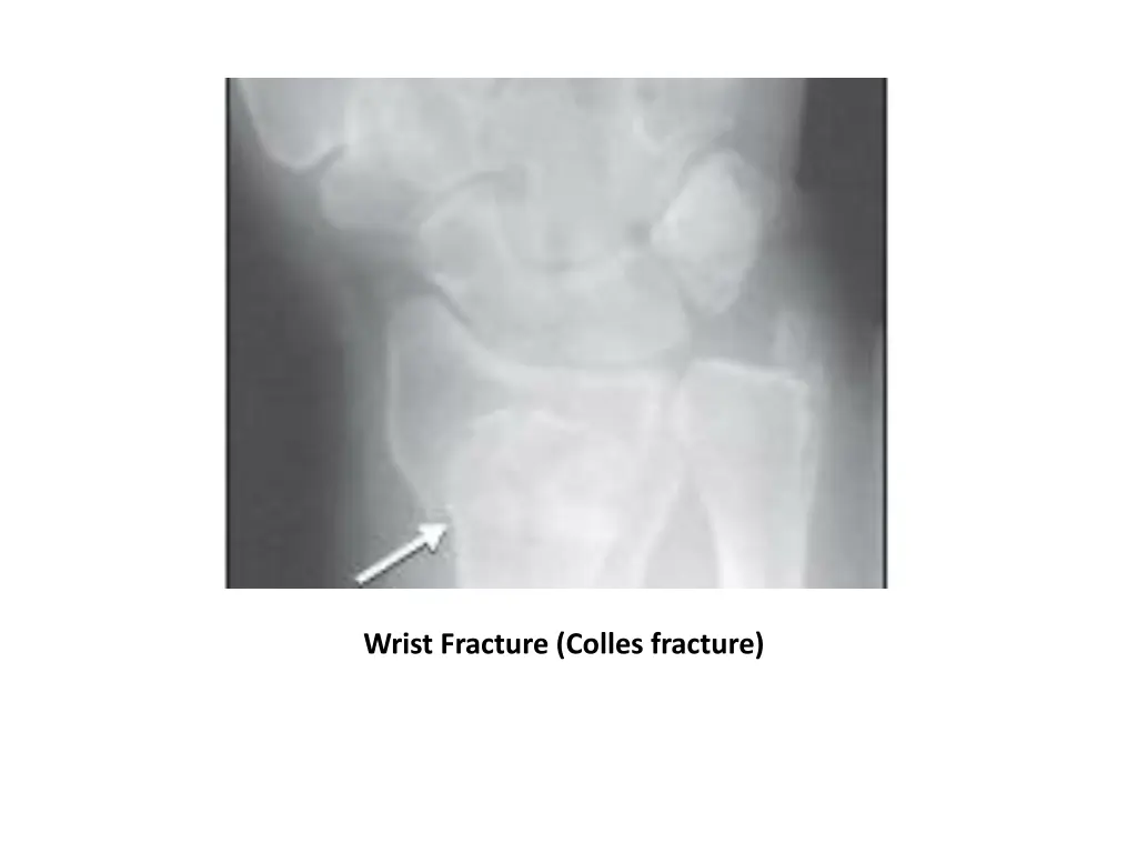 wrist fracture colles fracture