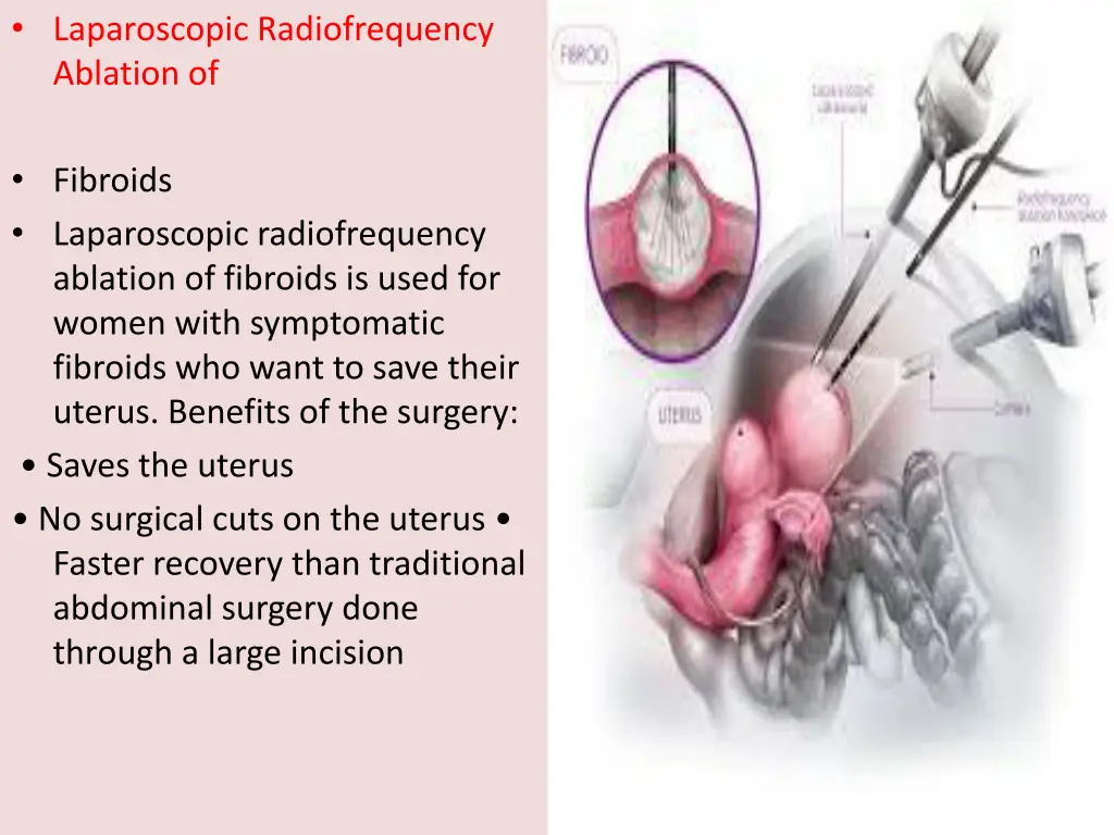 laparoscopic radiofrequency ablation of