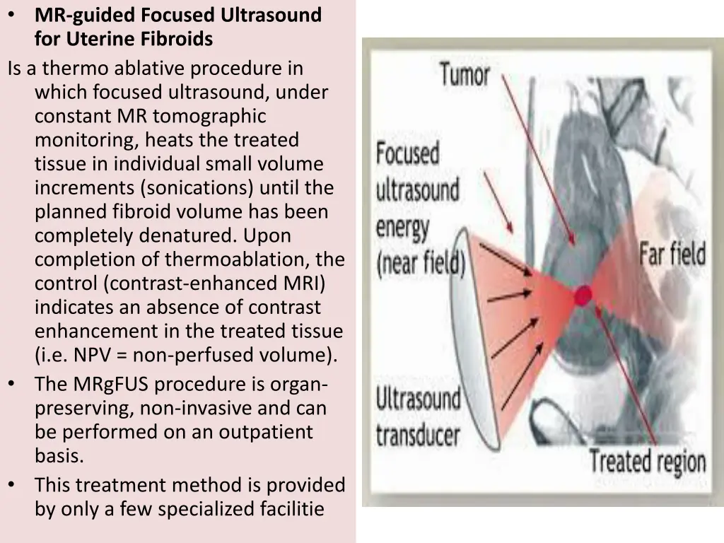 mr guided focused ultrasound for uterine fibroids