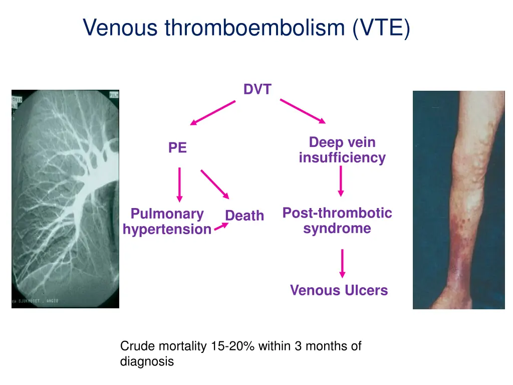 venous thromboembolism vte