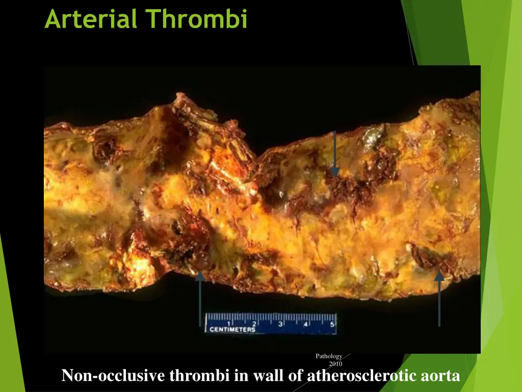 arterial thrombi 1