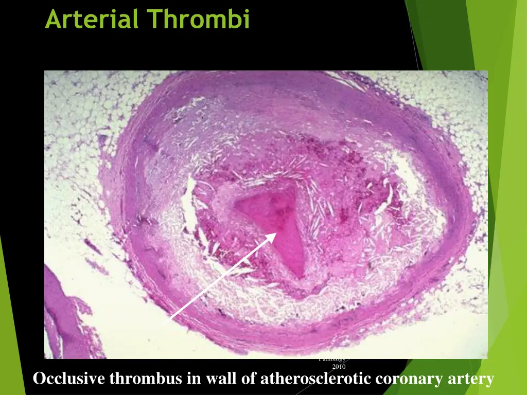 arterial thrombi 2