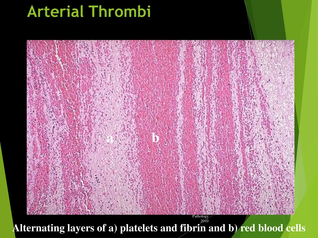 arterial thrombi 3