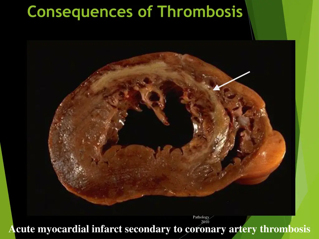 consequences of thrombosis 1