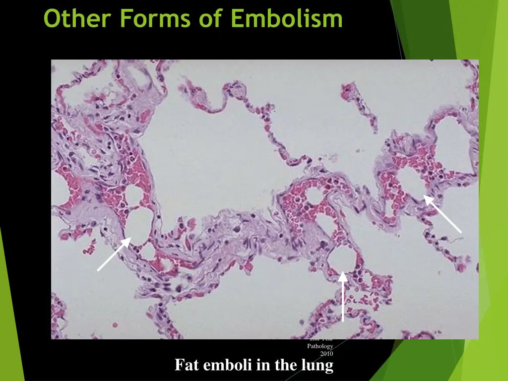 other forms of embolism 1