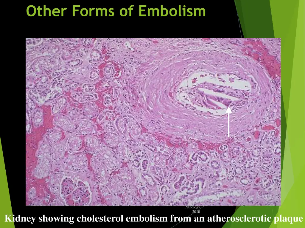 other forms of embolism 3