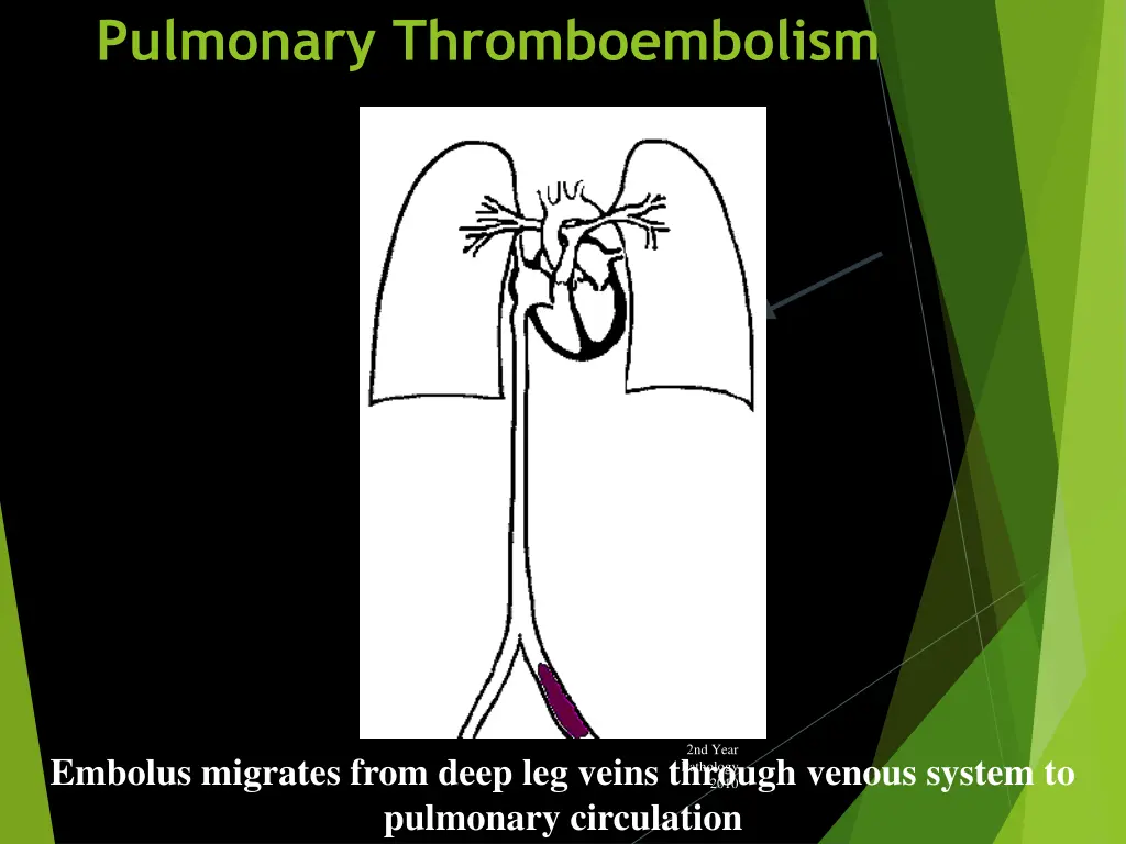 pulmonary thromboembolism 1