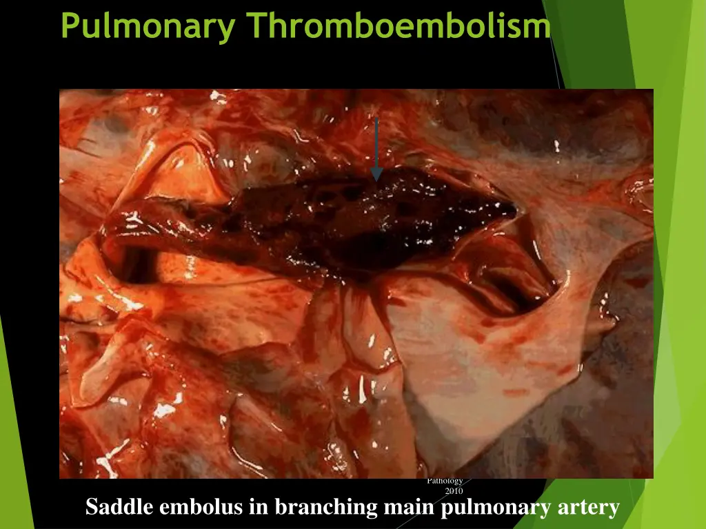 pulmonary thromboembolism 2