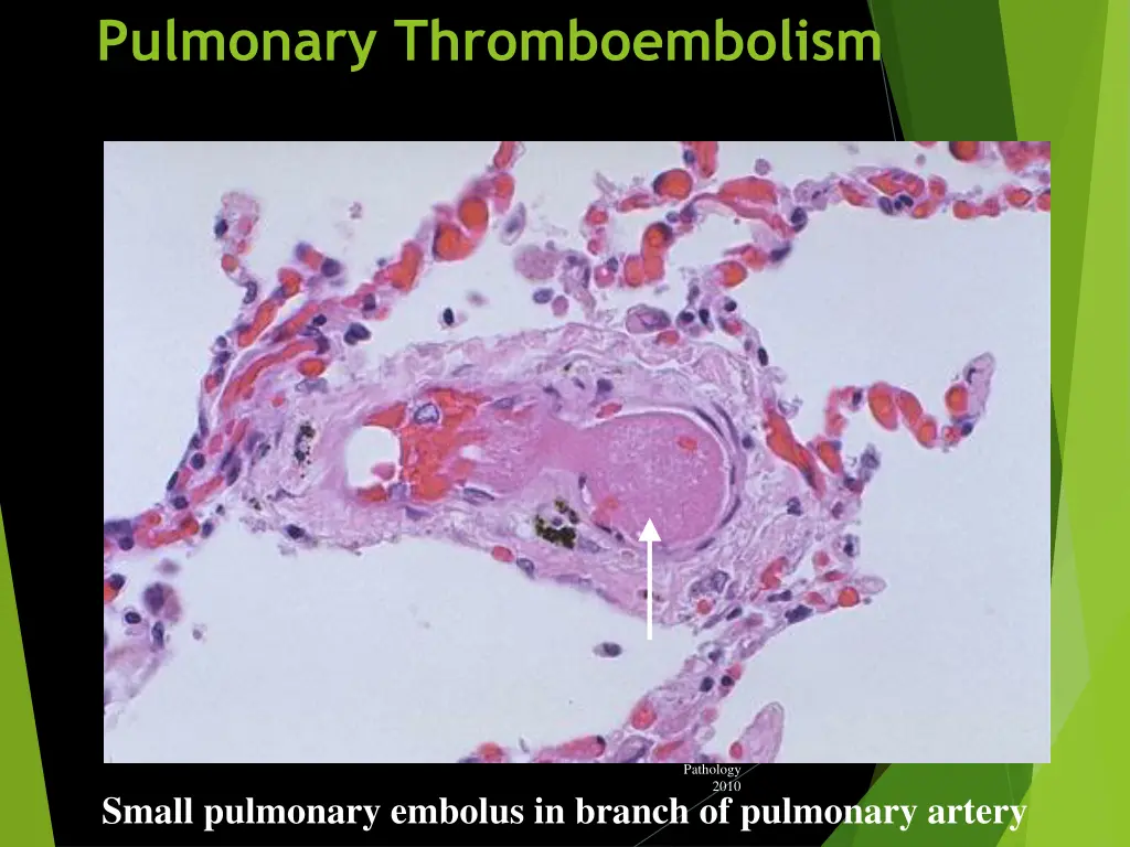 pulmonary thromboembolism 3