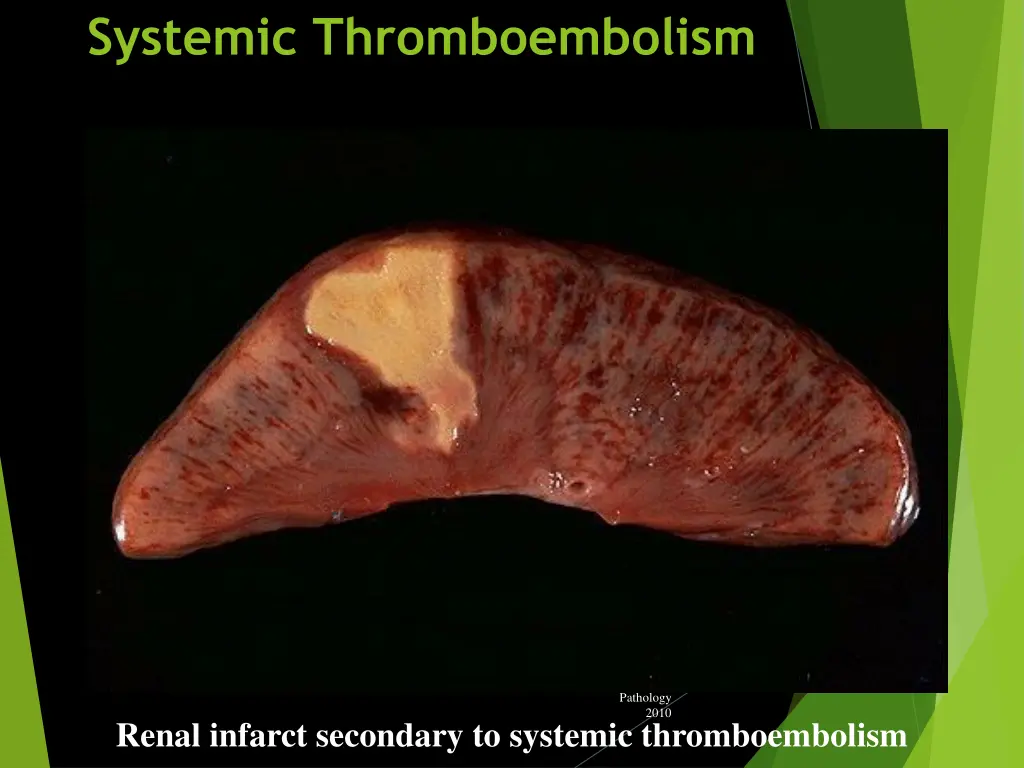 systemic thromboembolism 2