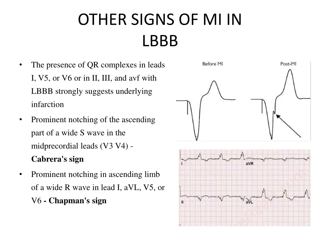 other signs of mi in lbbb