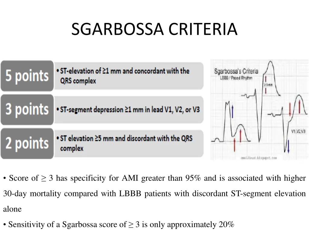 sgarbossa criteria
