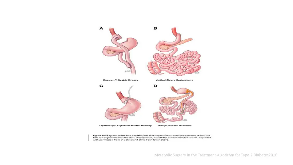 metabolic surgery in the treatment algorithm