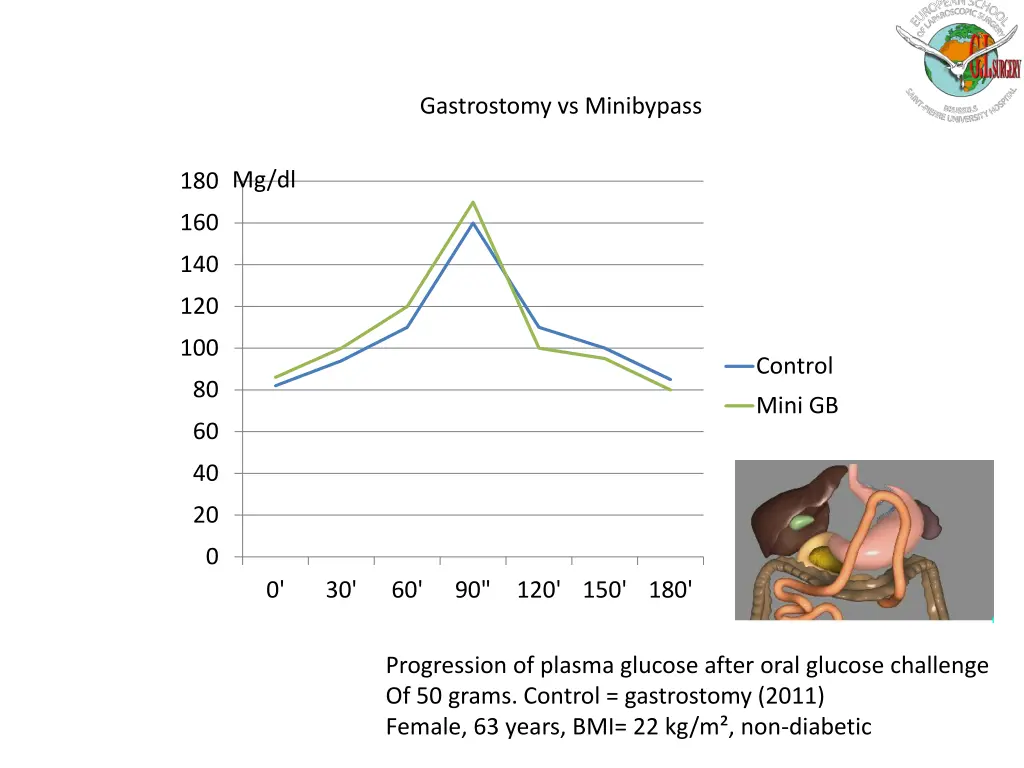 gastrostomy vs minibypass