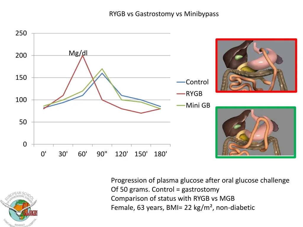 rygb vs gastrostomy vs minibypass