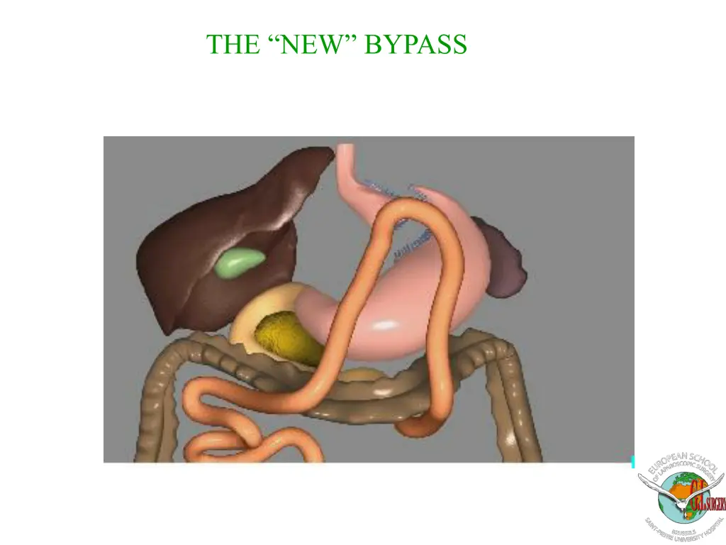 the new bypass 3