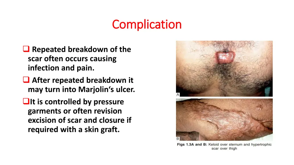 complication complication