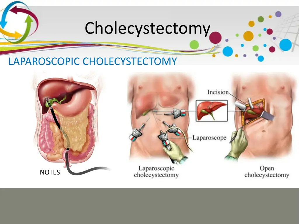 cholecystectomy 5