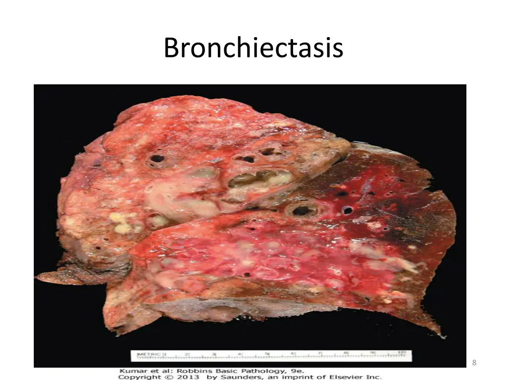bronchiectasis