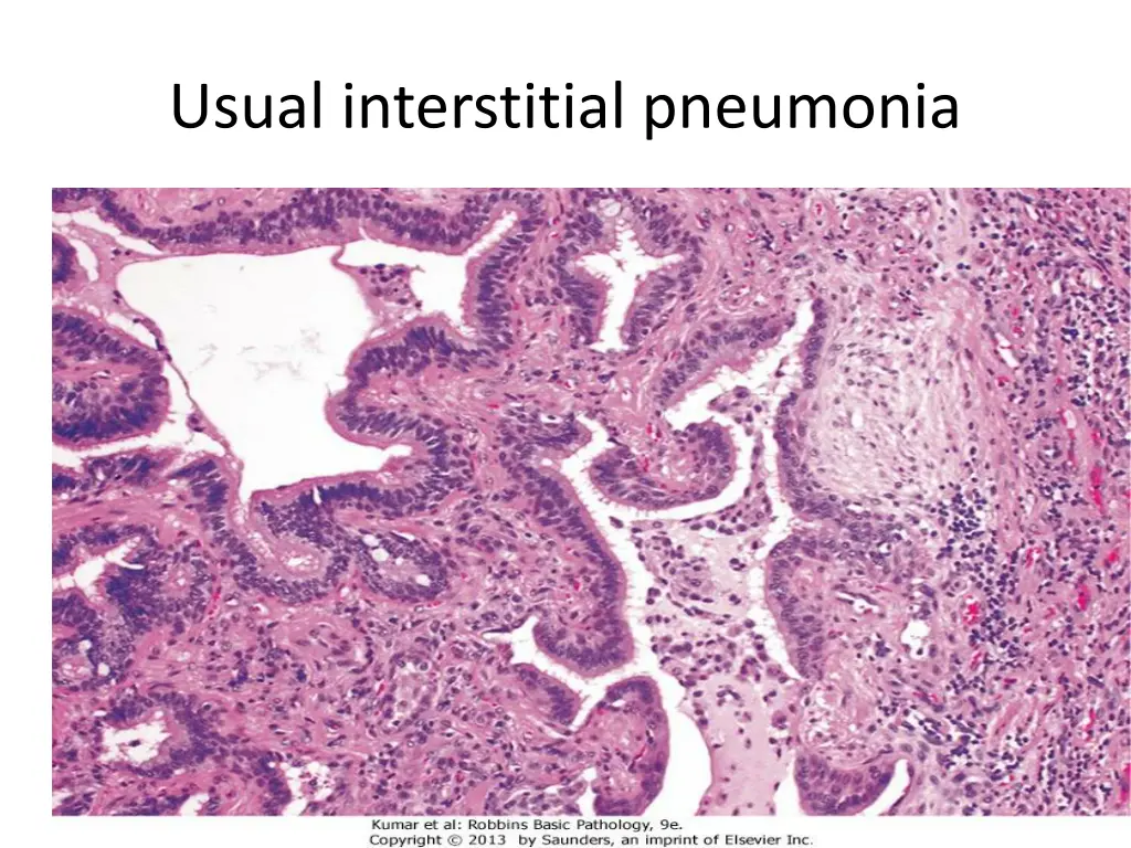 usual interstitial pneumonia 1