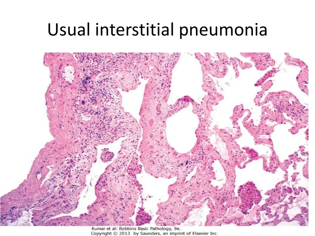 usual interstitial pneumonia