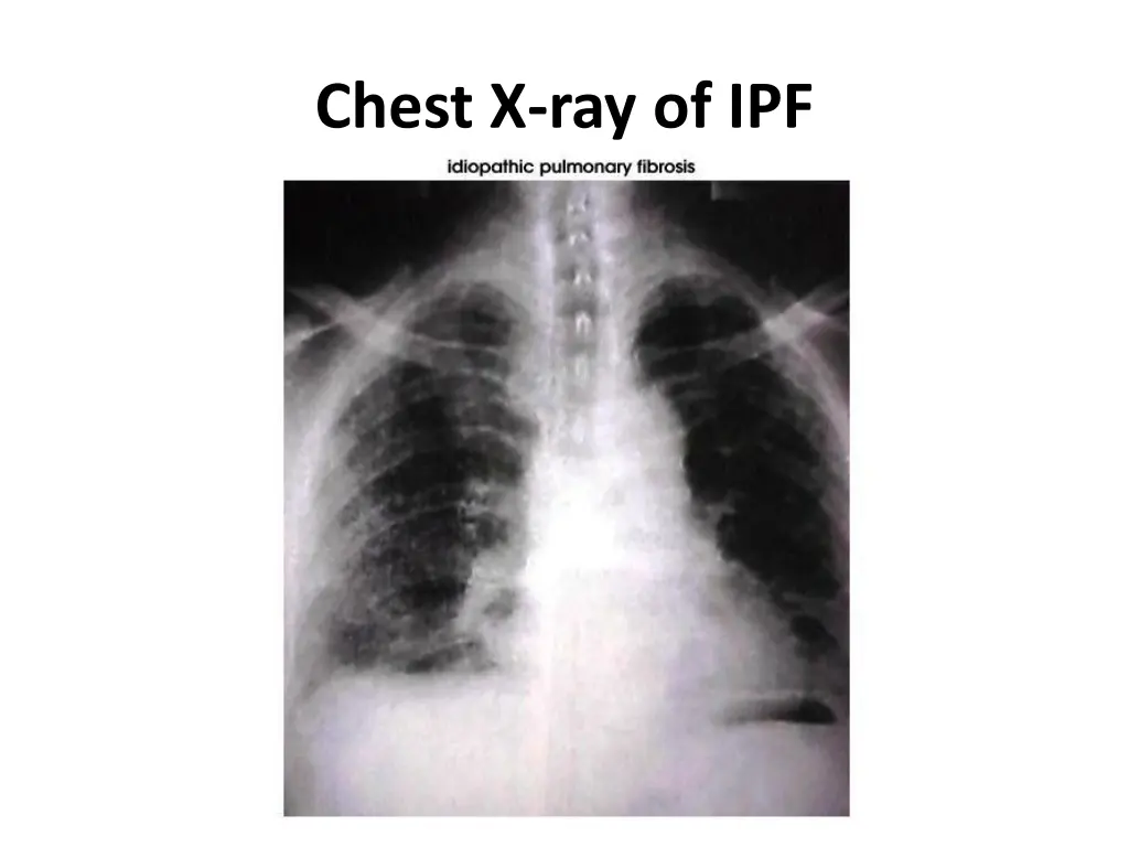 chest x ray of ipf