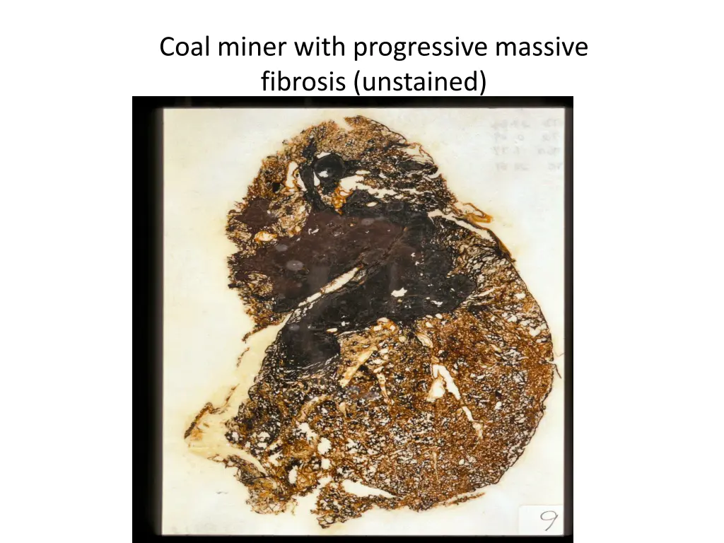 coal miner with progressive massive fibrosis