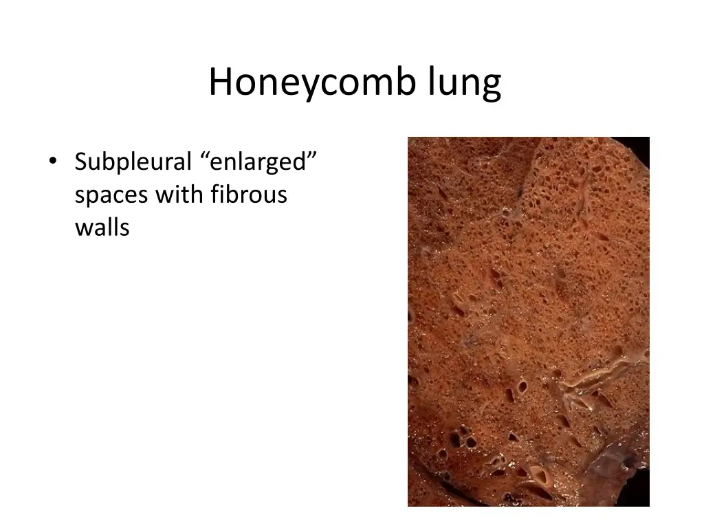 honeycomb lung