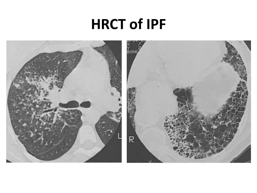 hrct of ipf