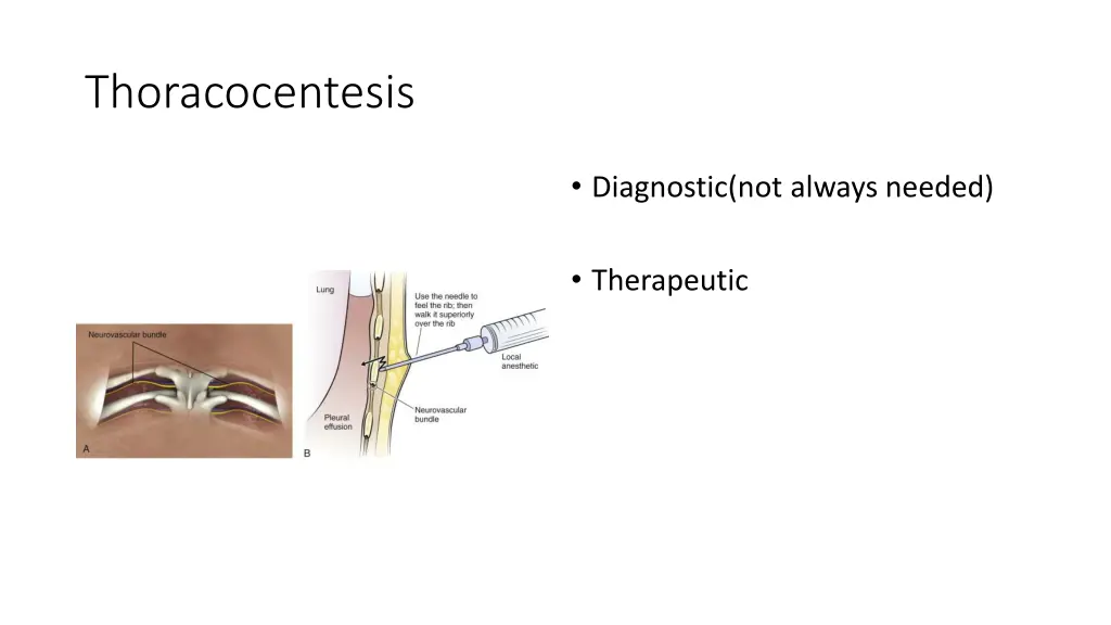 thoracocentesis