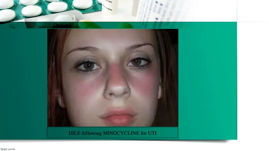dile following minocycline for uti