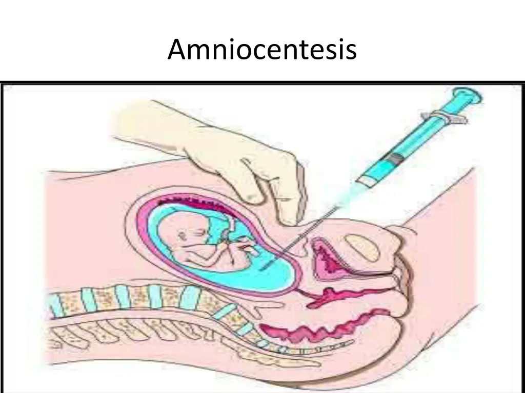 amniocentesis 1