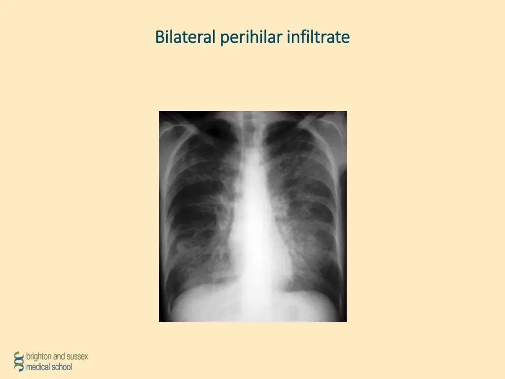 bilateral perihilar infiltrate bilateral