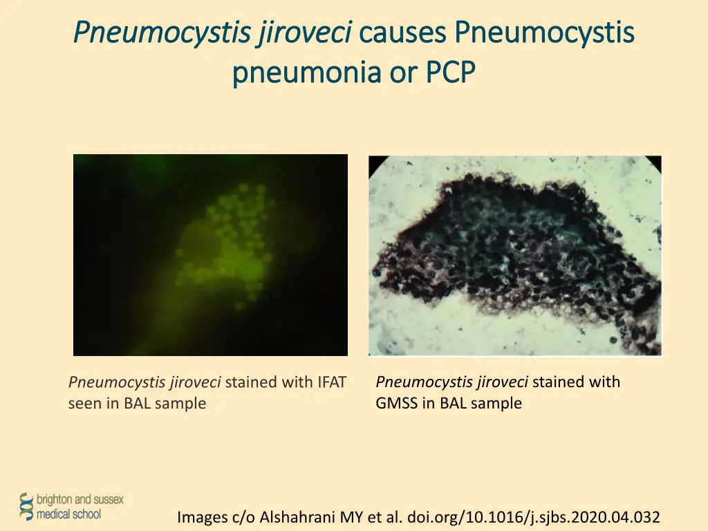 pneumocystis pneumocystis jiroveci