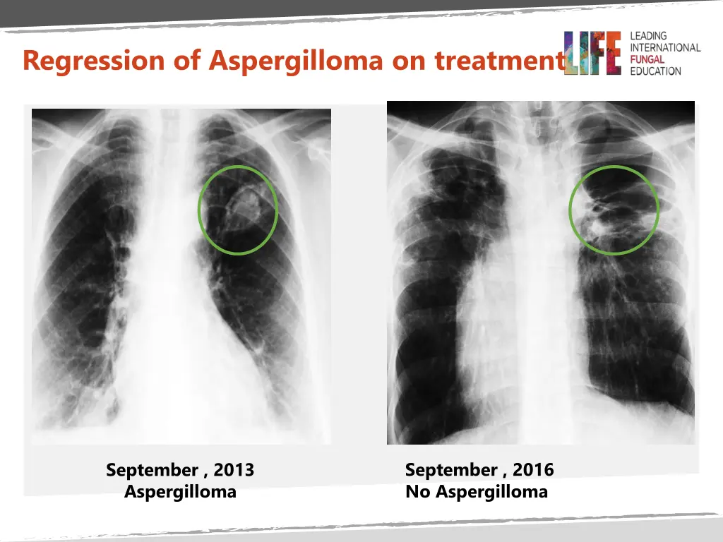 regression of aspergilloma on treatment