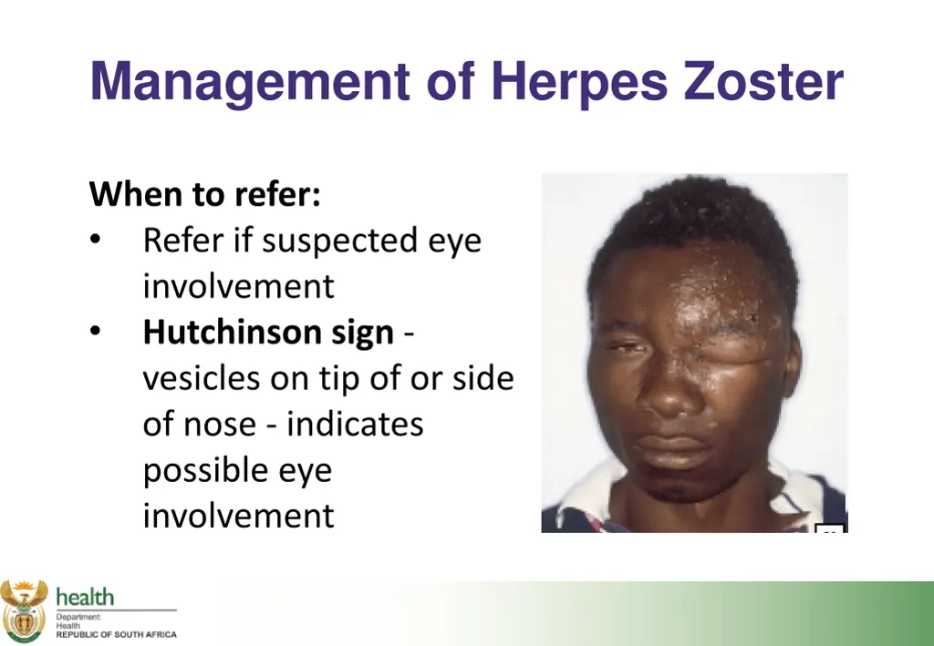 management of herpes zoster