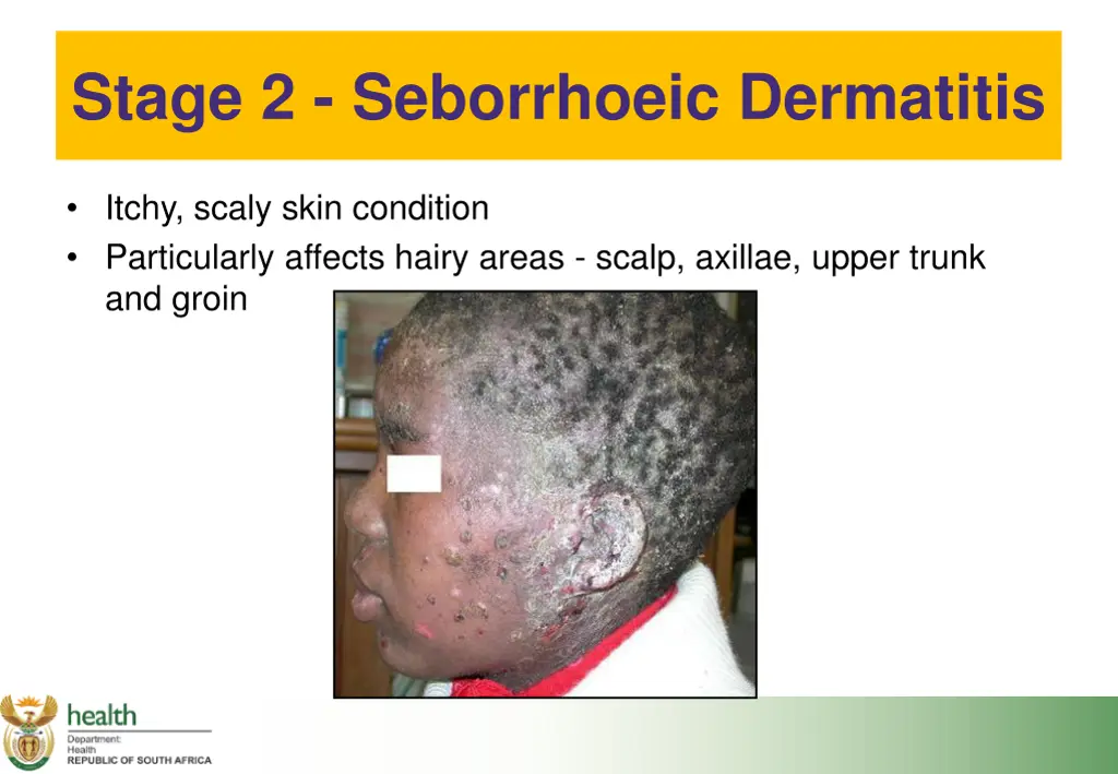 stage 2 seborrhoeic dermatitis