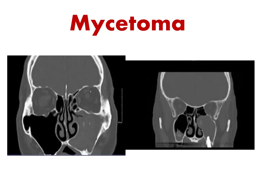 mycetoma 1