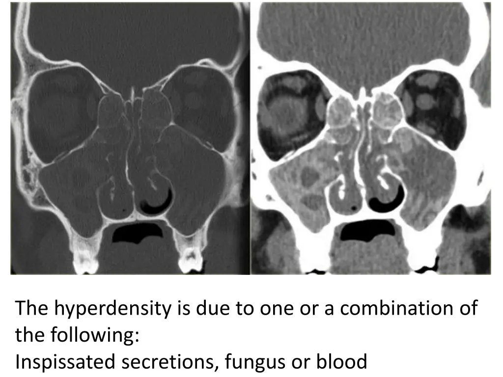 the hyperdensity is due to one or a combination