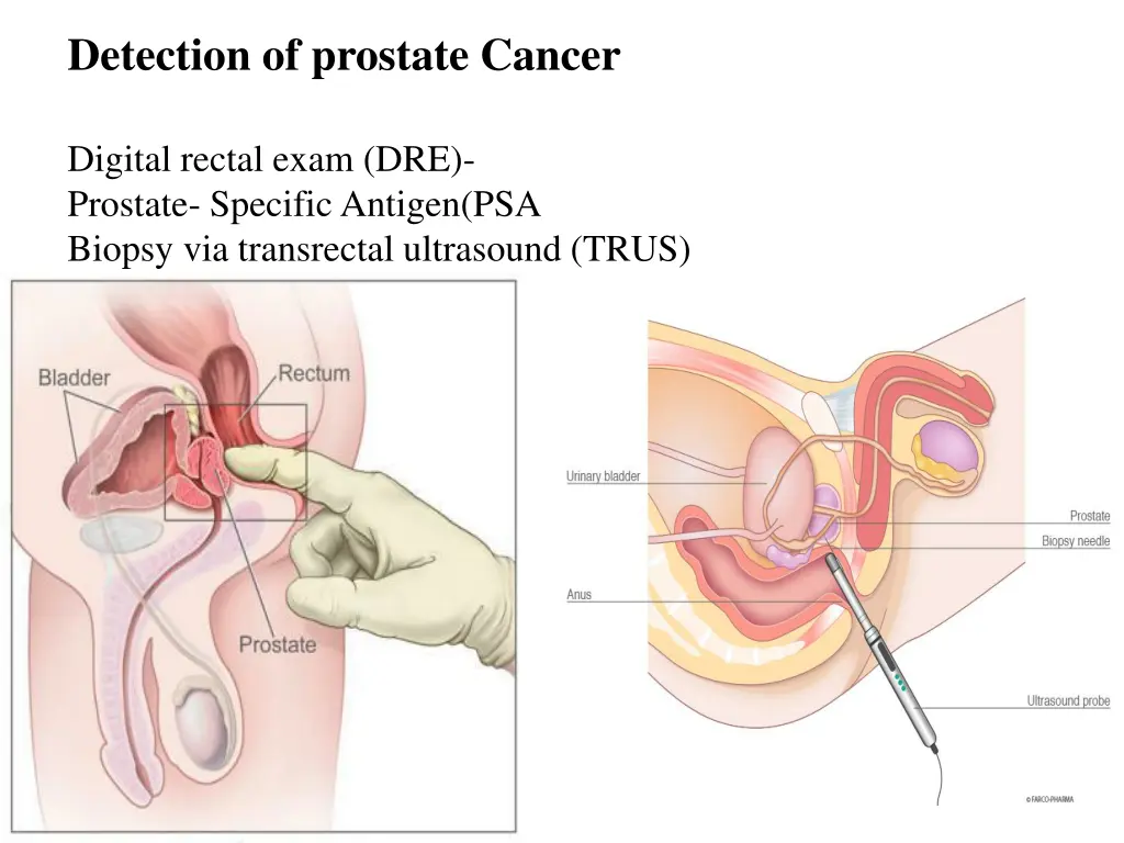detection of prostate cancer