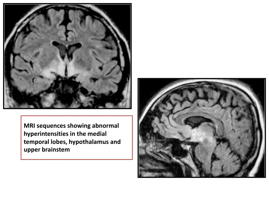 mri sequences showing abnormal hyperintensities