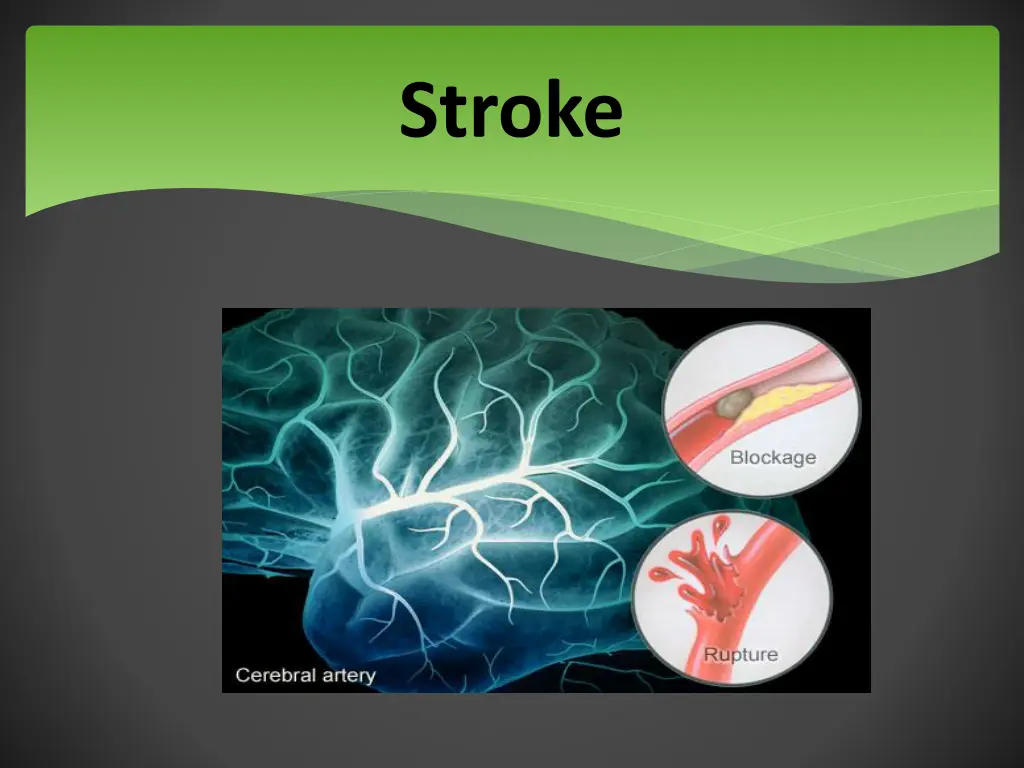 stroke