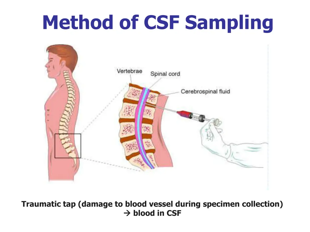 method of csf sampling