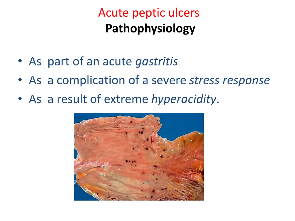 acute peptic ulcers pathophysiology